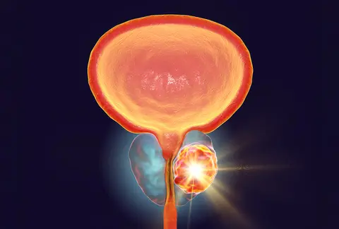 Hormone Therapy Unnecessary for Most Men Needing Post-Prostatectomy Radiotherapy